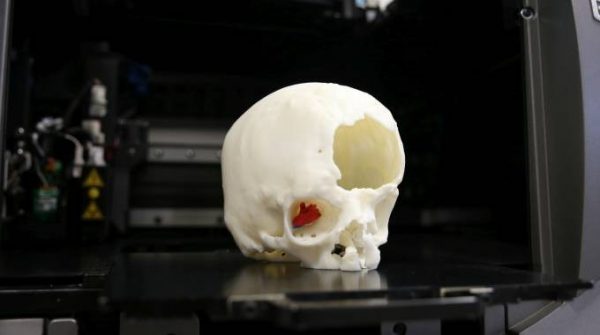 Ospedale Meyer, rimosso tumore grazie alla stampa 3D