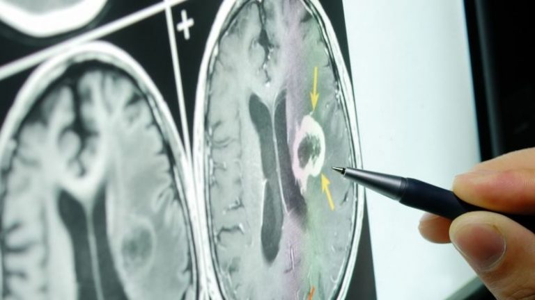 Scoperto il neurone bifronte causa della Sclerosi laterale amiotrofica