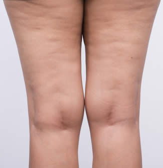 cellulite flaccida