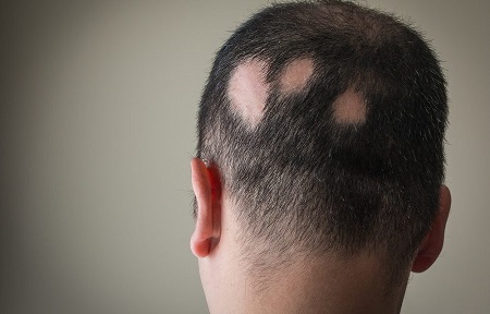 Alopecia areata: come combatterla con i rimedi naturali