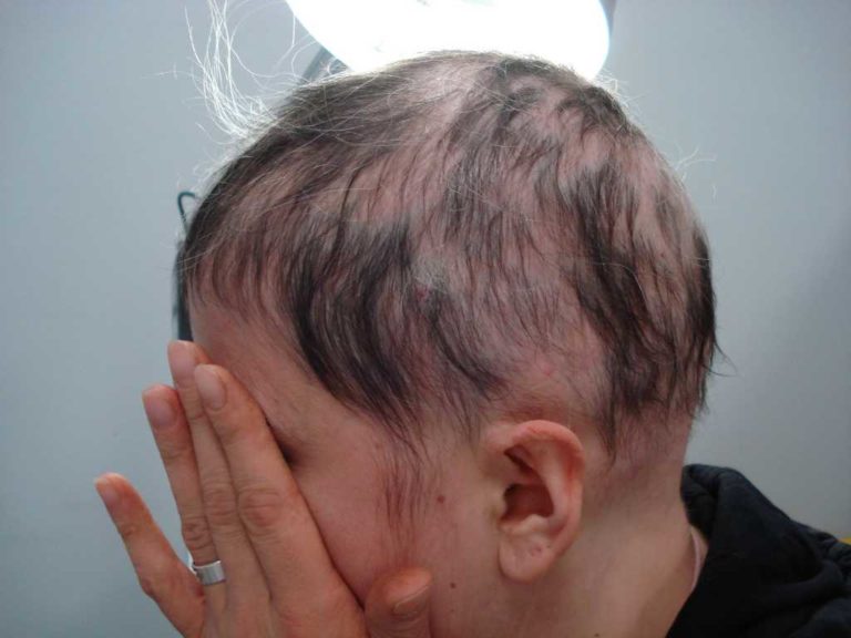 Alopecia: sintomi, cause, fattori di rischio e prevenzione