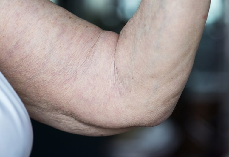 Cellulite flaccida: cos’è, cause e migliori rimedi del 2018