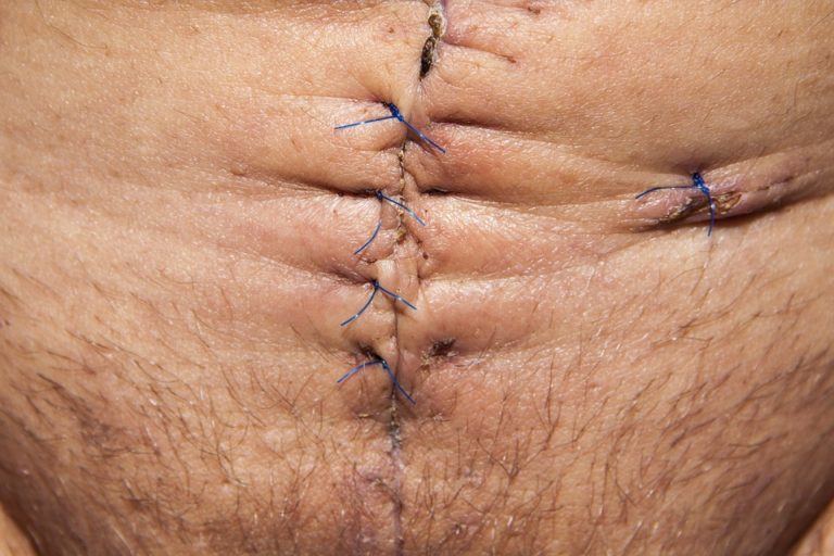 Cicatrici: cosa sono e trattamento chirurgico