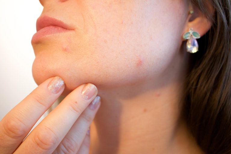Macchie cutanee: cosa sono, cause e trattamento laser