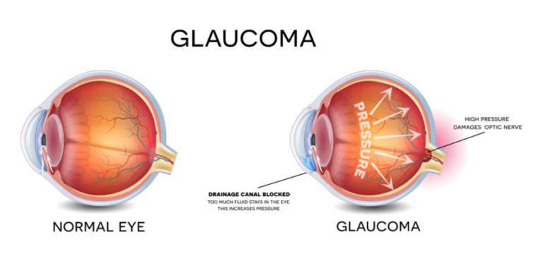 Trattamento e prevenzione del glaucoma