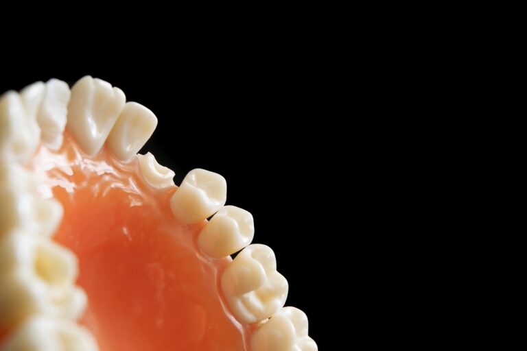 Come sostituire i denti mancanti?